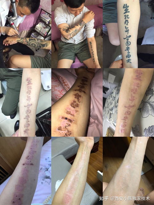 【专业解析】杭州纹身洗除哪家医院更胜一筹？